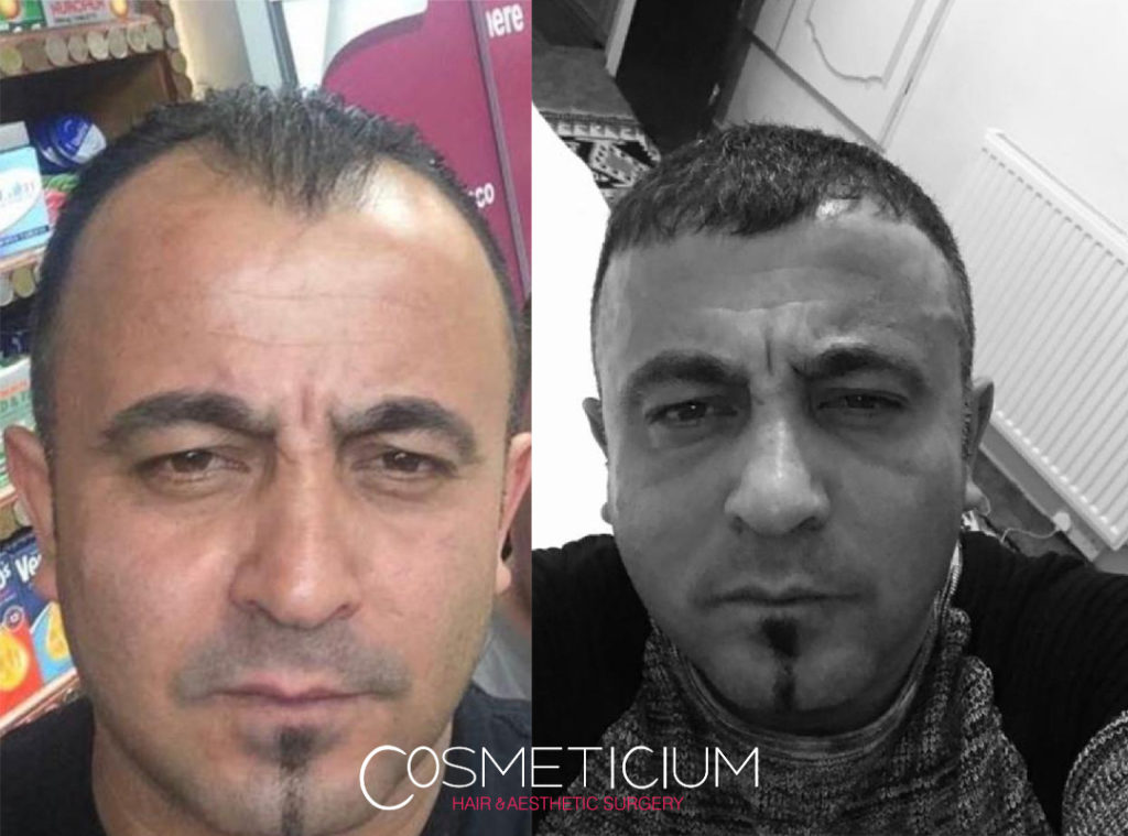 hair transplant at cosmeticium