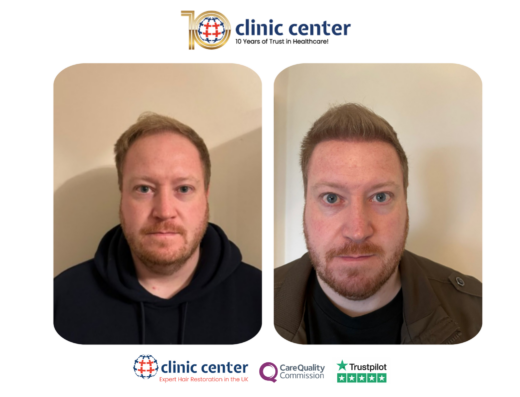 Clinic Center Hair Transplant